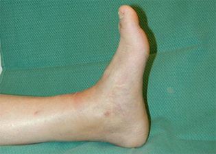 Post Operative - Total Ankle Joint Replacement - X-ray - Victorian Orthopaedic Foot & Ankle Clinic