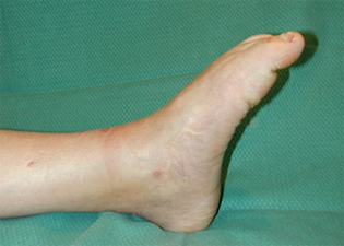 Post Operative - Total Ankle Joint Replacement - X-ray - Victorian Orthopaedic Foot & Ankle Clinic