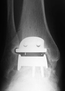 Post Operative - Total Ankle Joint Replacement - X-ray - Victorian Orthopaedic Foot & Ankle Clinic