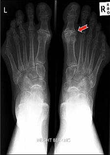 Pre Operative - Arthrodesis - X-ray - Victorian Orthopaedic Foot & Ankle Clinic