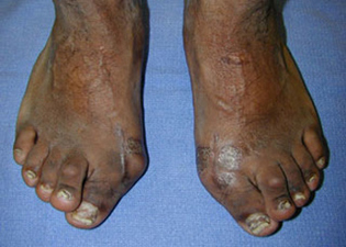 Pre Operative - Rheumatoid Arthritis - Victorian Orthopaedic Foot & Ankle Clinic