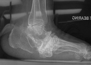 Severe Midfoot Arthritis - X-ray - Victorian Orthopaedic Foot & Ankle Clinic