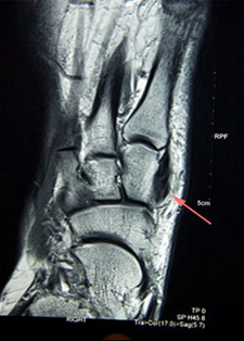 MRI - Tibialis Anterior Tendon - Victorian Orthopaedic Foot & Ankle Clinic