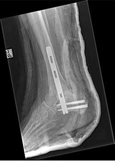 Post Operative - Tibio Talar Calcaneal Arthrodesis - X-ray - Victorian Orthopaedic Foot & Ankle Clinic