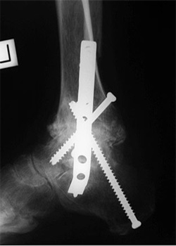 Post Operative - Tibio Talar Calcaneal Fusion - X-ray - Victorian Orthopaedic Foot & Ankle Clinic
