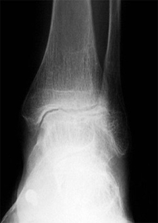 Post Operative - Total Ankle Joint Replacement - X-ray - Victorian Orthopaedic Foot & Ankle Clinic